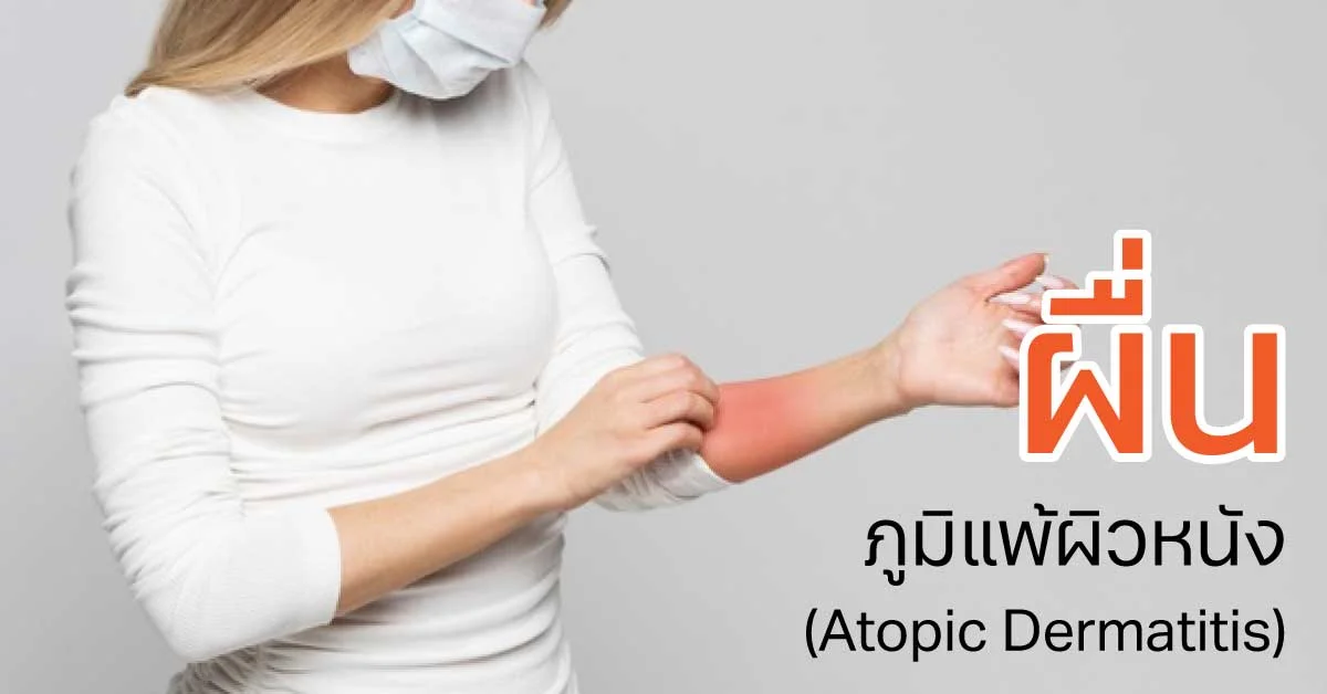 ผื่นภูมิแพ้ผิวหนัง (Atopic Dermatitis) สาเหตุ อาการ และแนวทางดูแล